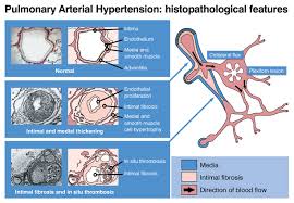 Ảnh 1 của Pulmonary Arterial Hypertension